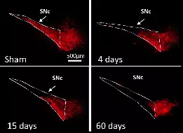 Progressive loss of dopamine neurons in the substantia nigra pars compacta (SNc delineated by dotted lines) in a model of PD based on dysfunction of excitatory amino acid transporters.